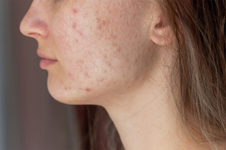 Why Acne Should be Treated Early