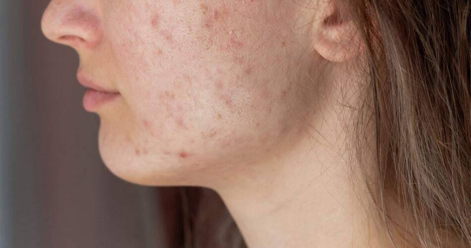Why Acne Should be Treated Early