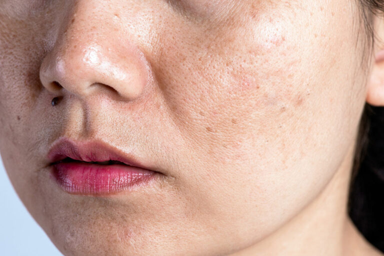 Melasma In Pregnancy: Causes & Prevention