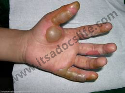 Second degree superficial burn
